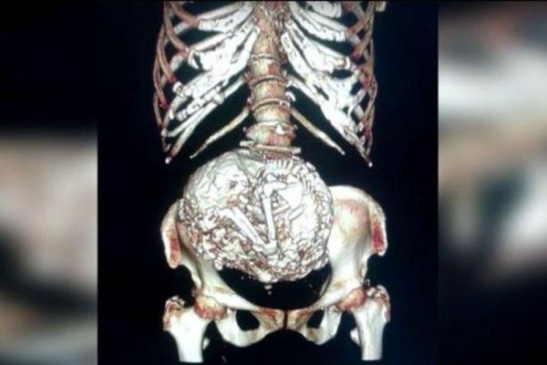 60ƻ̥ 91ϸ鷢ӹڲ60"ƻ̥"(ͼ)